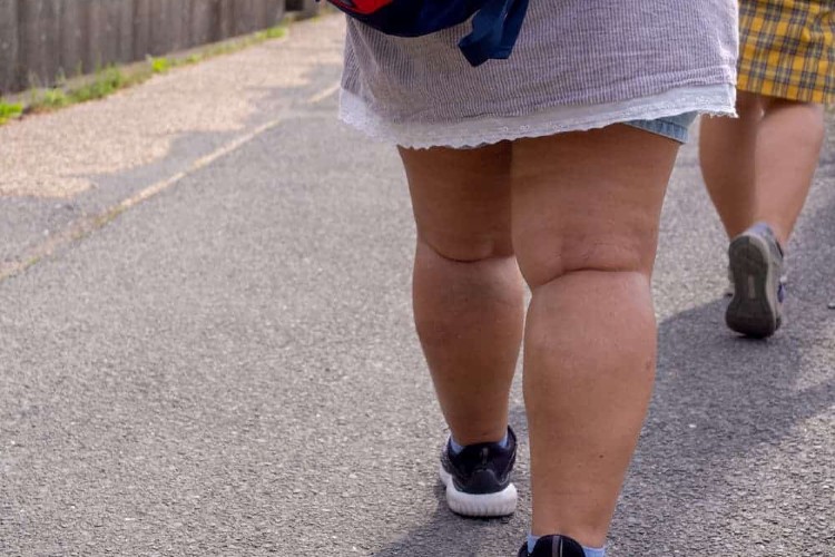 Acúmulo de gordura nas pernas e braços pode ser sinal de lipedema - GAZ -  Notícias de Santa Cruz do Sul e Região